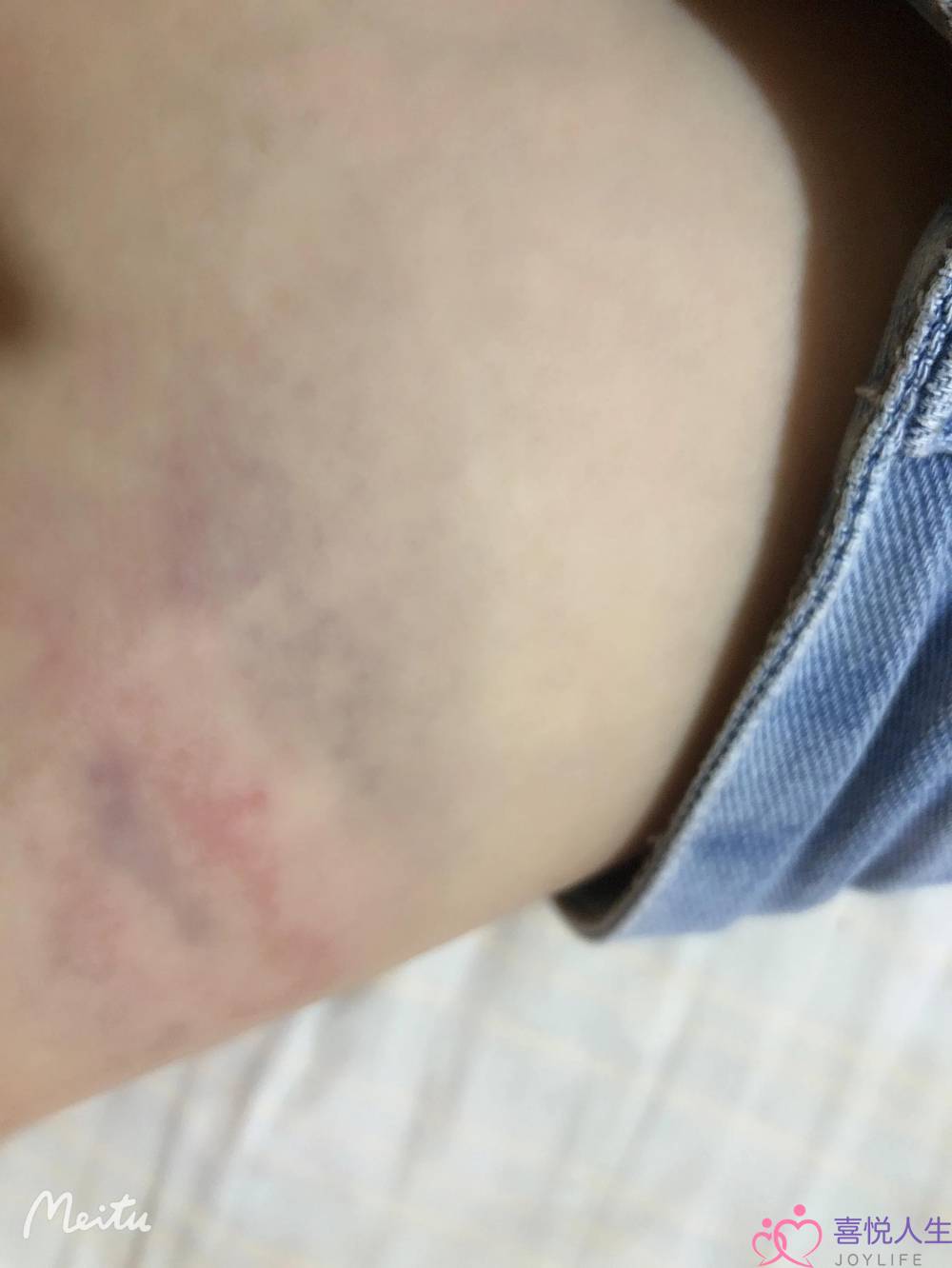 相处三年的男友为了一个已婚女人居然动手打我